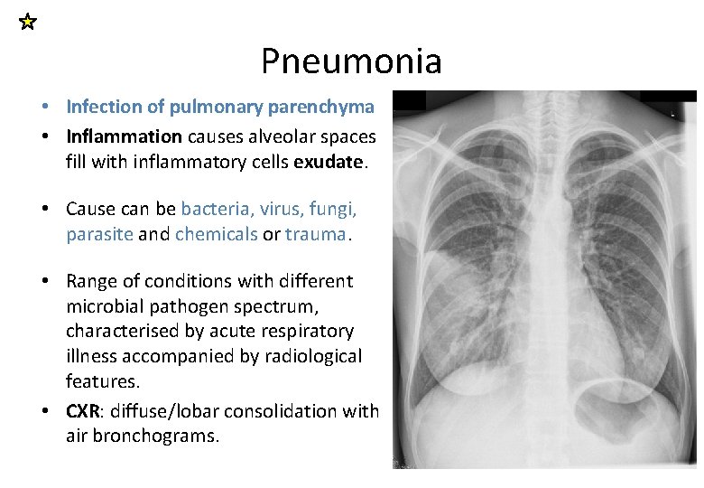 Pneumonia • Infection of pulmonary parenchyma • Inflammation causes alveolar spaces fill with inflammatory