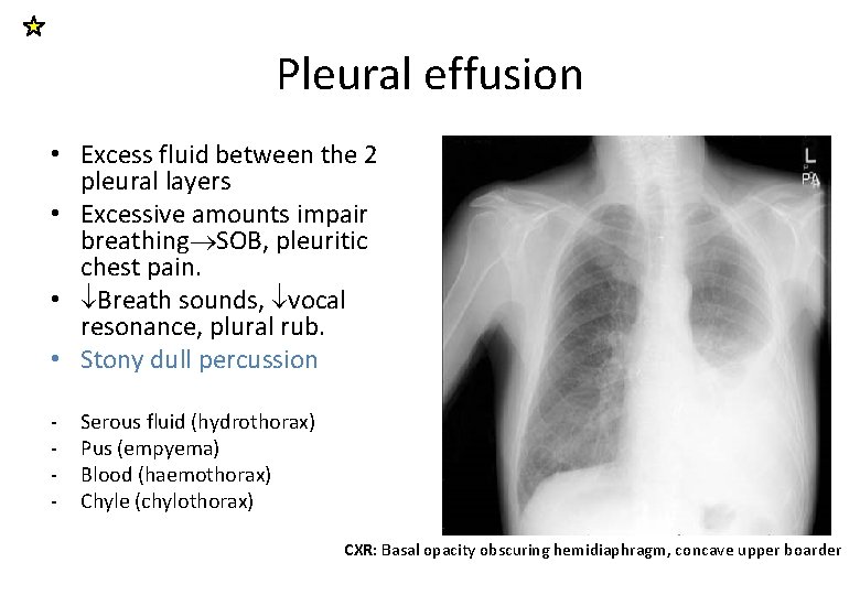 Pleural effusion • Excess fluid between the 2 pleural layers • Excessive amounts impair