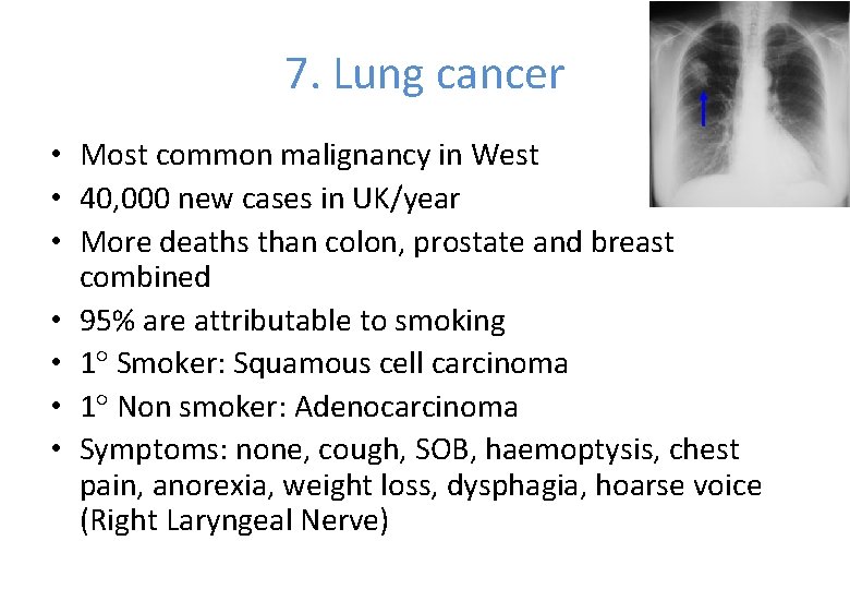 7. Lung cancer • Most common malignancy in West • 40, 000 new cases