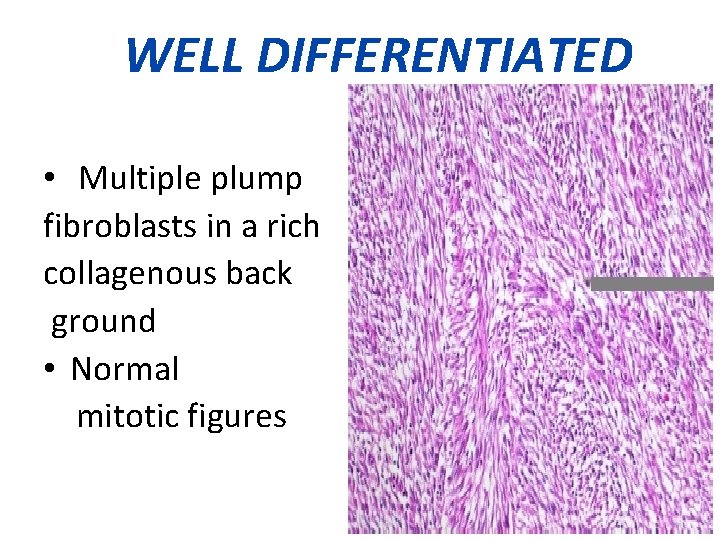 WELL DIFFERENTIATED • Multiple plump fibroblasts in a rich collagenous back ground • Normal