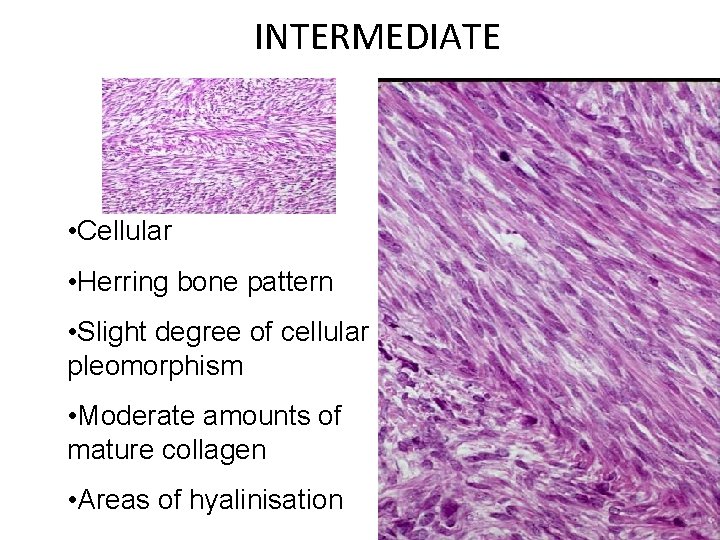 INTERMEDIATE • Cellular • Herring bone pattern • Slight degree of cellular pleomorphism •