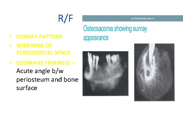 R/F • SUNRAY PATTERN • WIDENING OF PERIODONTAL SPACE • CODMANS TRIANGLE – Acute