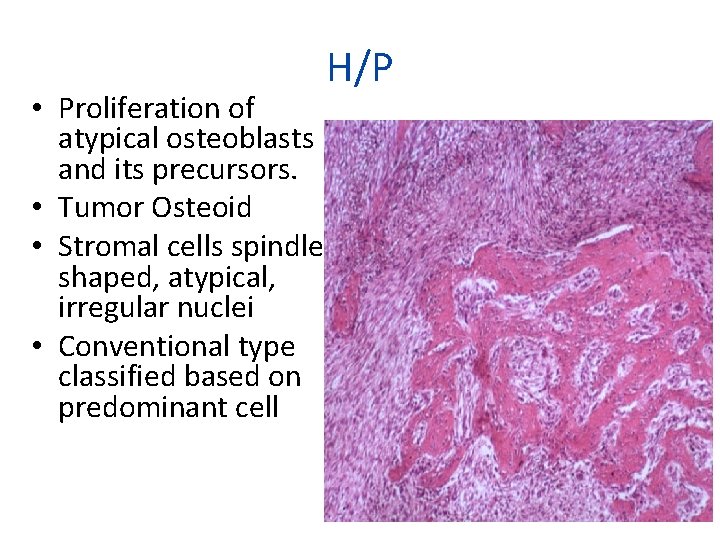  • Proliferation of atypical osteoblasts and its precursors. • Tumor Osteoid • Stromal