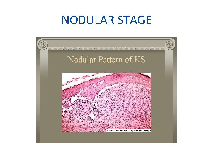 NODULAR STAGE 