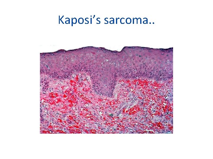 Kaposi’s sarcoma. . 