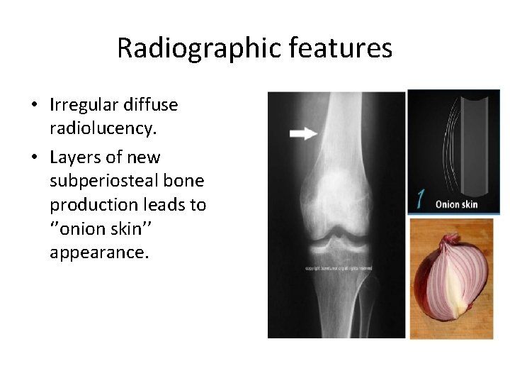 Radiographic features • Irregular diffuse radiolucency. • Layers of new subperiosteal bone production leads