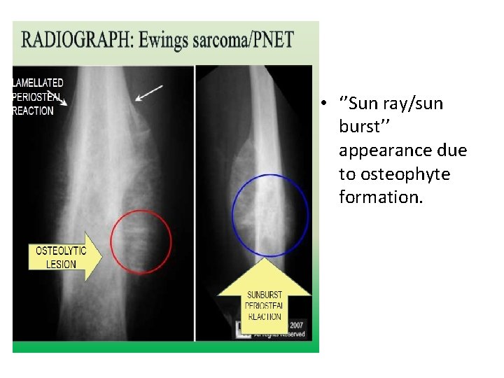  • ‘’Sun ray/sun burst’’ appearance due to osteophyte formation. 