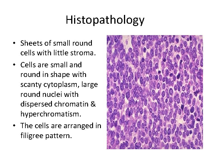 Histopathology • Sheets of small round cells with little stroma. • Cells are small