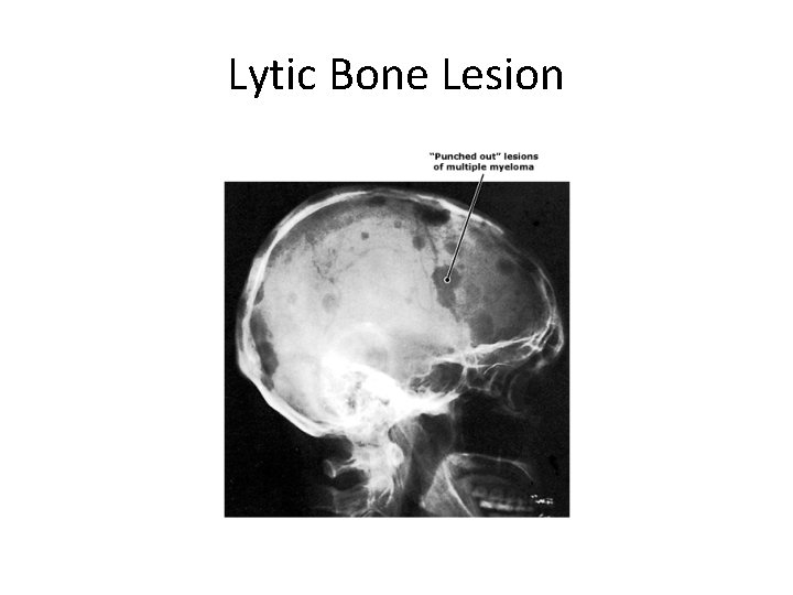 Lytic Bone Lesion 