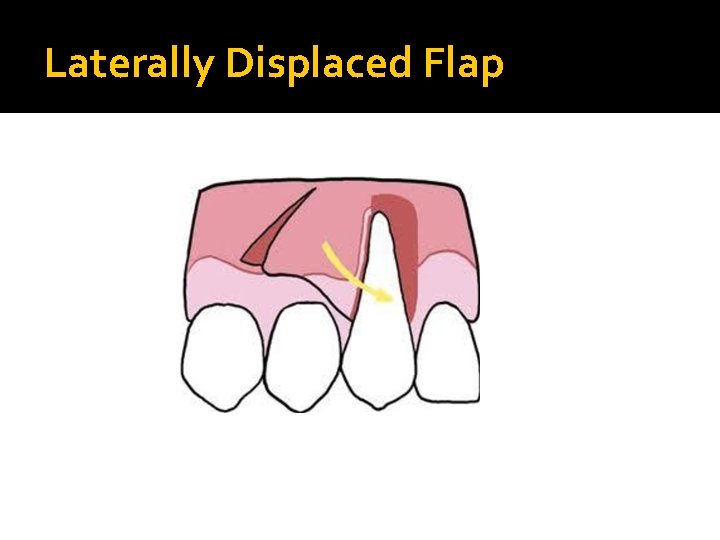 Laterally Displaced Flap 