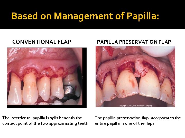 Based on Management of Papilla: CONVENTIONAL FLAP The interdental papilla is split beneath the