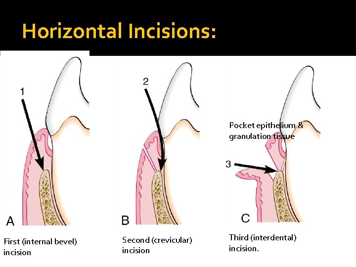 Horizontal Incisions: Pocket epithelium & granulation tissue First (internal bevel) incision Second (crevicular) incision