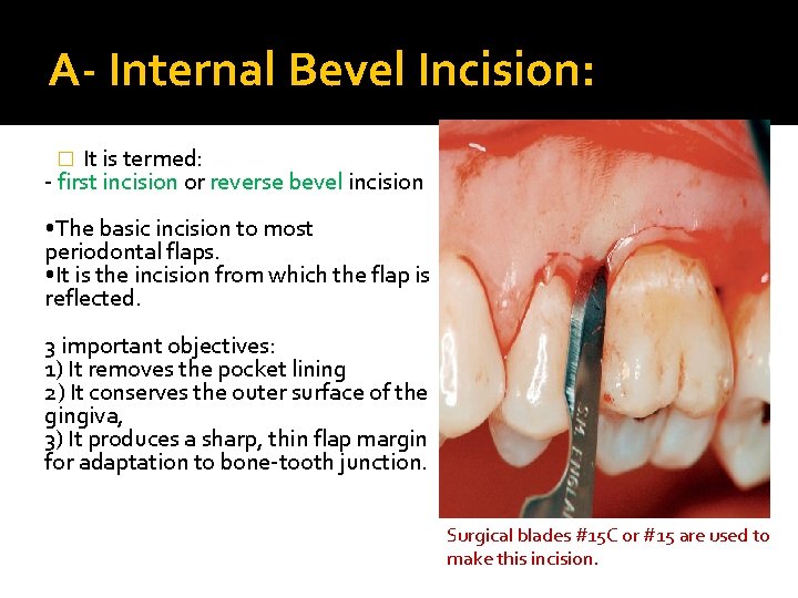 A- Internal Bevel Incision: It is termed: - first incision or reverse bevel incision