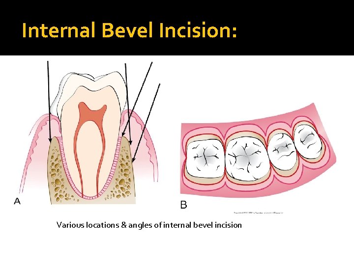 Internal Bevel Incision: Various locations & angles of internal bevel incision 