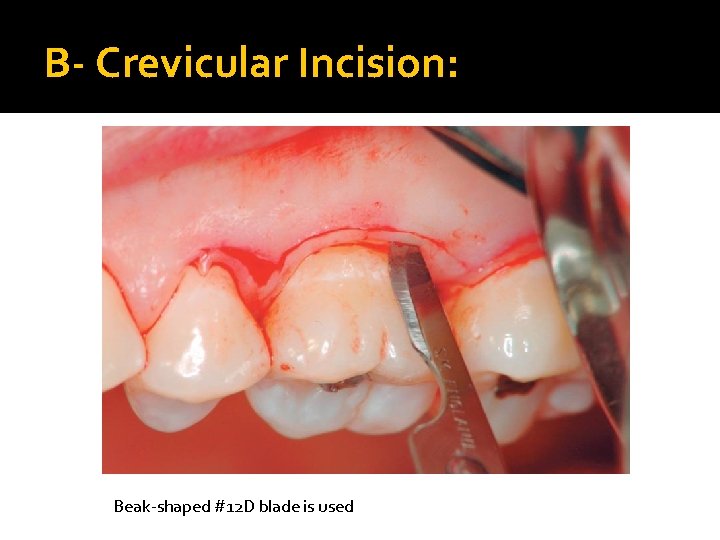 B- Crevicular Incision: Beak-shaped #12 D blade is used 