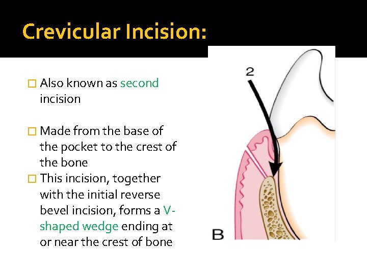 Crevicular Incision: � Also known as second incision � Made from the base of