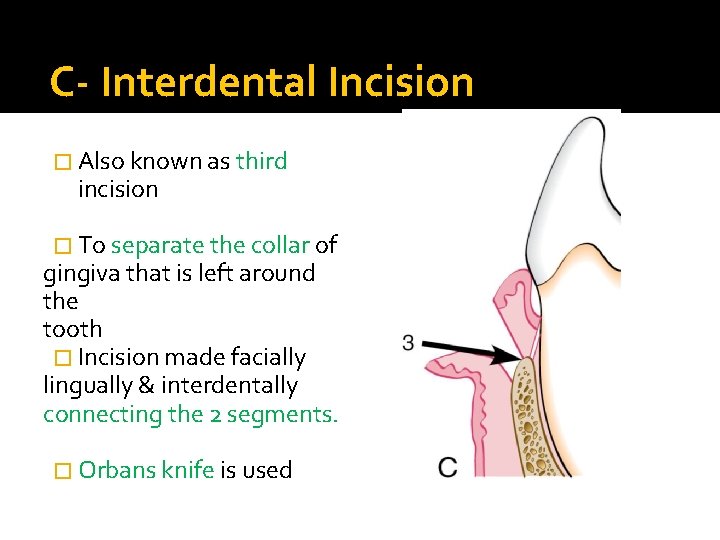 C- Interdental Incision � Also known as third incision � To separate the collar