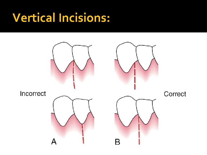Vertical Incisions: 