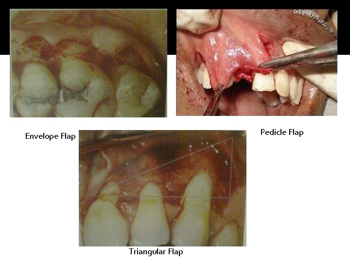 Pedicle Flap Envelope Flap Triangular Flap 