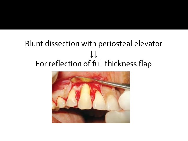 Blunt dissection with periosteal elevator ↓↓ For reflection of full thickness flap 