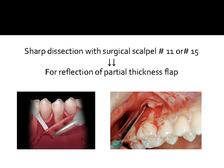 Sharp dissection with surgical scalpel # 11 or# 15 ↓↓ For reflection of partial