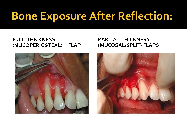 Bone Exposure After Reflection: FULL-THICKNESS (MUCOPERIOSTEAL) FLAP PARTIAL-THICKNESS (MUCOSAL/SPLIT) FLAPS 