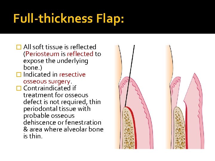 Full-thickness Flap: � All soft tissue is reflected (Periosteum is reflected to expose the