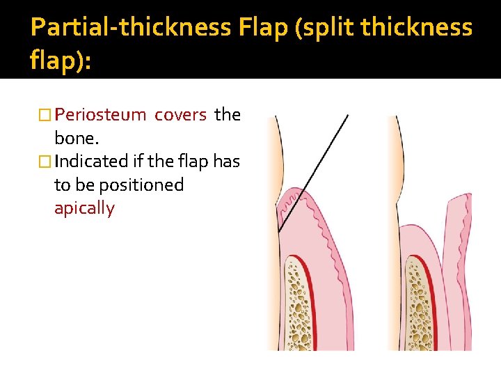 Partial-thickness Flap (split thickness flap): � Periosteum covers the bone. � Indicated if the