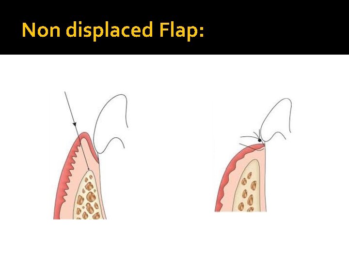 Non displaced Flap: 