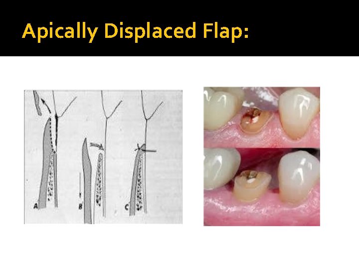 Apically Displaced Flap: 