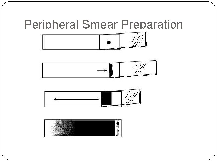 Peripheral Smear Preparation Peripheral Smear Preparation