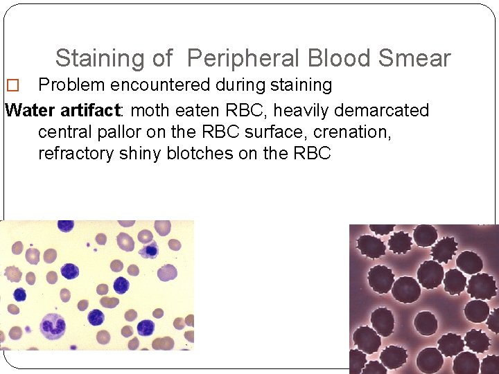 Staining of Peripheral Blood Smear Problem encountered during staining Water artifact: moth eaten RBC, Staining of Peripheral Blood Smear Problem encountered during staining Water artifact: moth eaten RBC,
