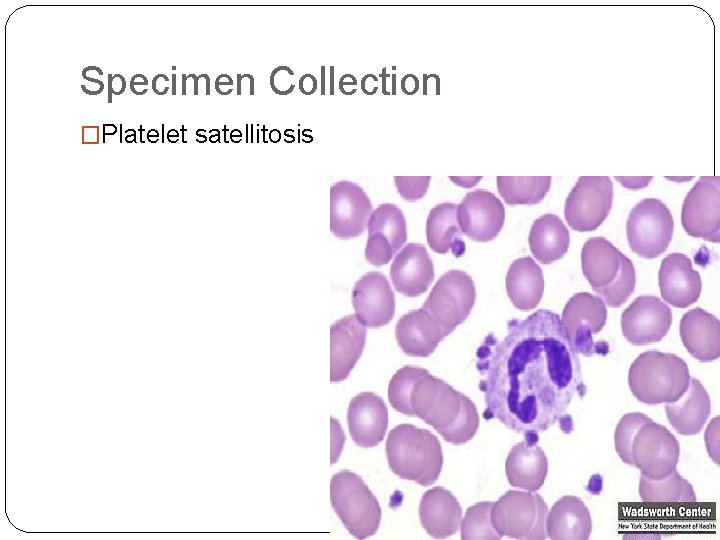 Specimen Collection �Platelet satellitosis Specimen Collection �Platelet satellitosis