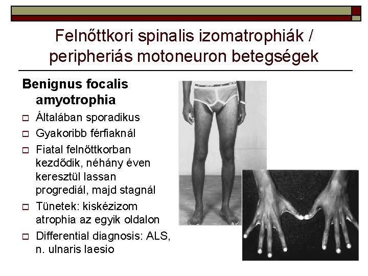 Felnőttkori spinalis izomatrophiák / peripheriás motoneuron betegségek Benignus focalis amyotrophia o o o Általában