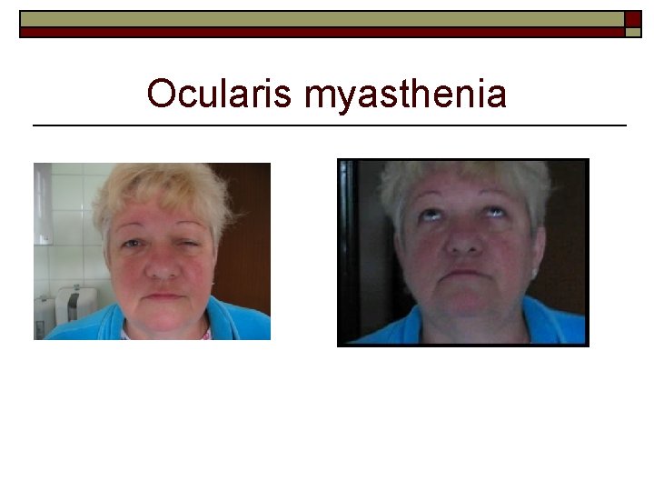 Ocularis myasthenia 