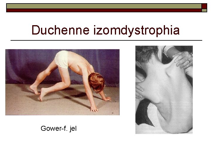 Duchenne izomdystrophia Gower-f. jel 