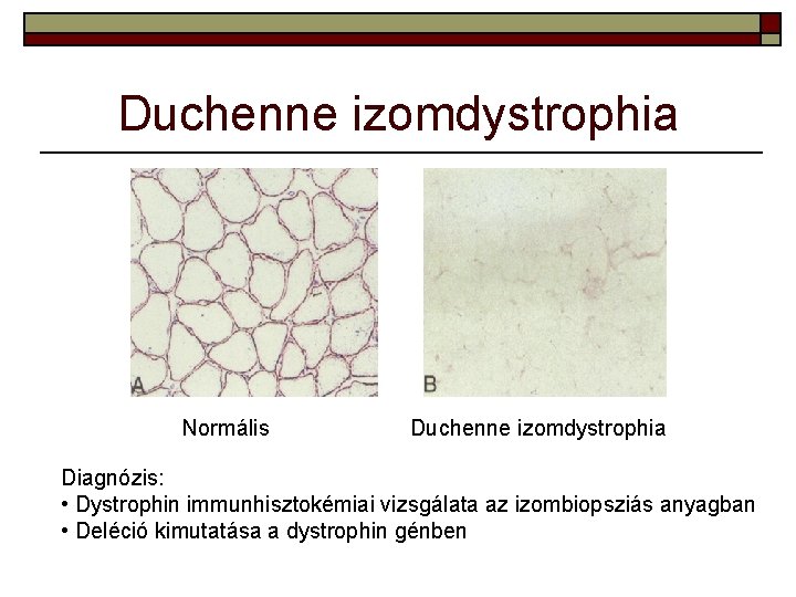 Duchenne izomdystrophia Normális Duchenne izomdystrophia Diagnózis: • Dystrophin immunhisztokémiai vizsgálata az izombiopsziás anyagban •