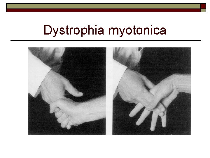 Dystrophia myotonica 