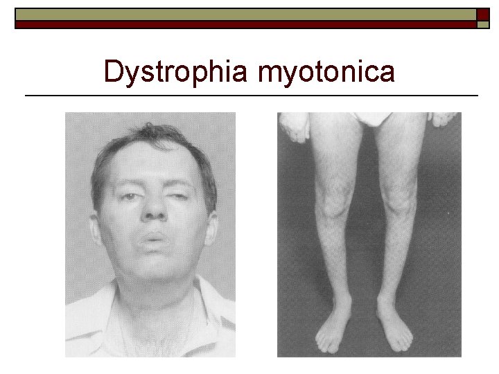 Dystrophia myotonica 