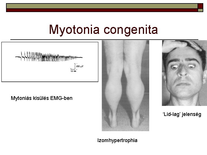 Myotonia congenita Mytoniás kisülés EMG-ben ‘Lid-lag’ jelenség Izomhypertrophia 