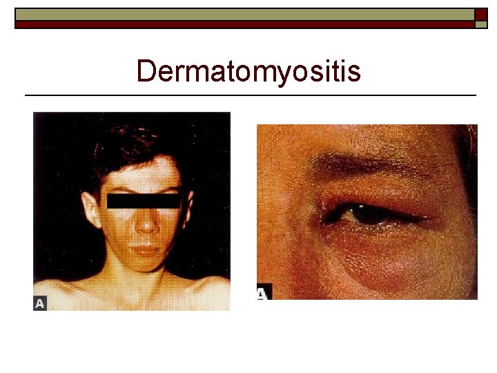 Dermatomyositis 