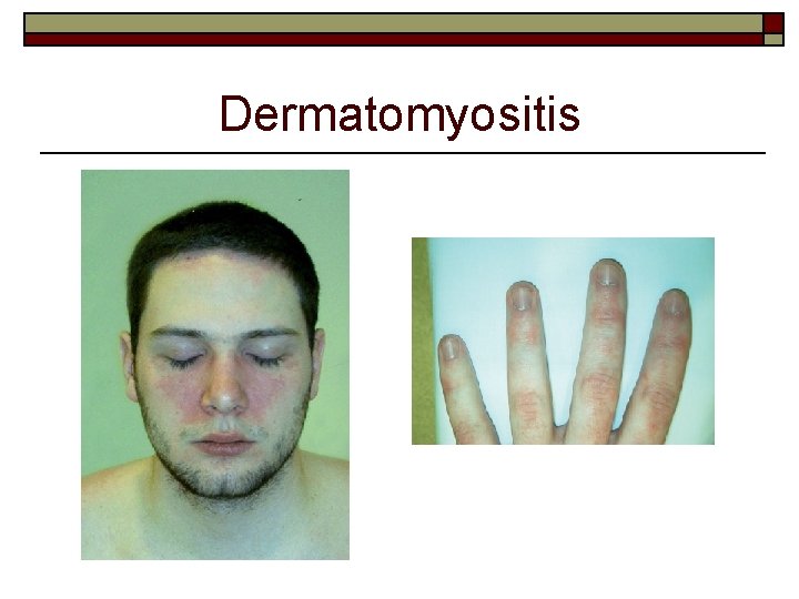 Dermatomyositis 