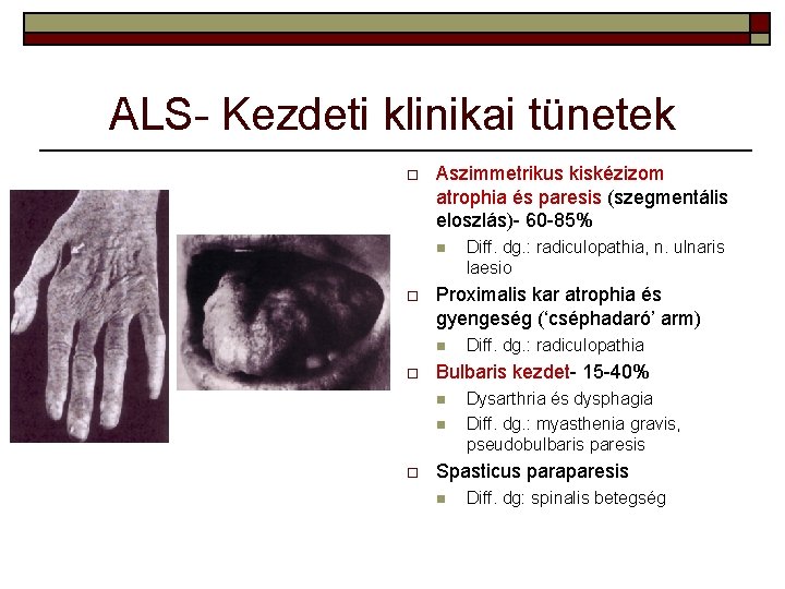ALS- Kezdeti klinikai tünetek o Aszimmetrikus kiskézizom atrophia és paresis (szegmentális eloszlás)- 60 -85%