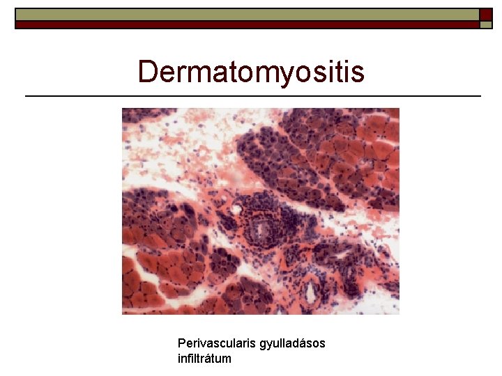 Dermatomyositis Perivascularis gyulladásos infiltrátum 