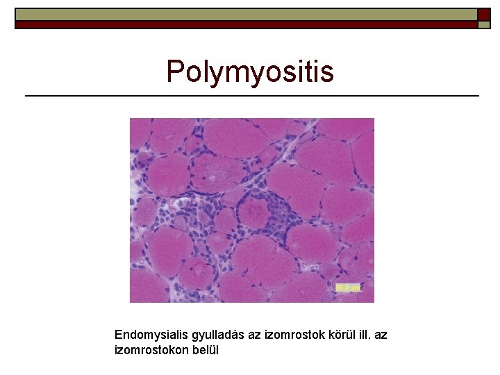 Polymyositis Endomysialis gyulladás az izomrostok körül ill. az izomrostokon belül 
