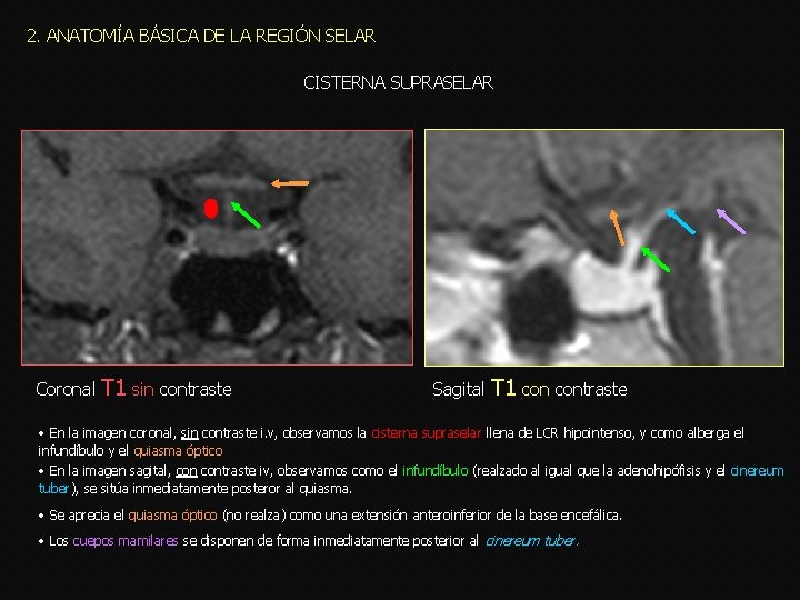 2. ANATOMÍA BÁSICA DE LA REGIÓN SELAR CISTERNA SUPRASELAR Coronal T 1 sin contraste