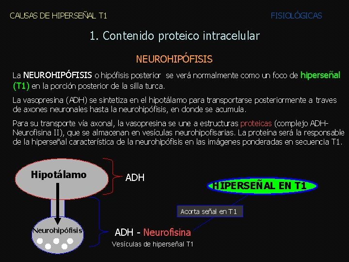 CAUSAS DE HIPERSEÑAL T 1 FISIOLÓGICAS 1. Contenido proteico intracelular NEUROHIPÓFISIS La NEUROHIPÓFISIS o