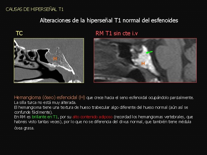 CAUSAS DE HIPERSEÑAL T 1 Alteraciones de la hiperseñal T 1 normal del esfenoides