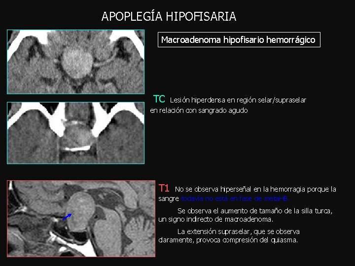 APOPLEGÍA HIPOFISARIA Macroadenoma hipofisario hemorrágico TC Lesión hiperdensa en región selar/supraselar en relación con