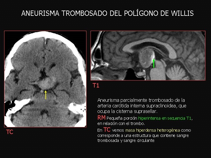 ANEURISMA TROMBOSADO DEL POLÍGONO DE WILLIS T 1 Aneurisma parcialmente trombosado de la arteria